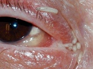 Una mosca depone le uova nell’occhio di una paziente, i medici le rimuovono 120 vermi